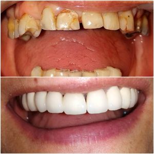 Metalokeramicke krunice, zarkovo, moj stomatolog beograd