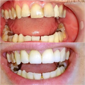 Bezmetalne krunice, moj stomatolog zarkovo, beograd