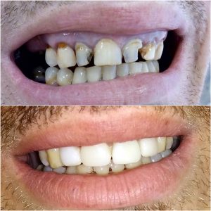 Fasete moj stomatolog zarkovo, beograd