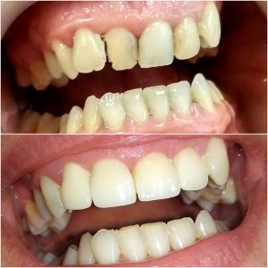 Bezmetalne krunice, moj stomatolog zarkovo, beograd