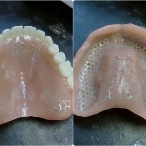 Akrilatna proteza moj stomatolog zarkovo, beograd