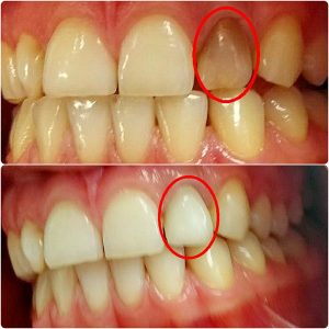 Bezmetalne krunice, moj stomatolog zarkovo, beograd