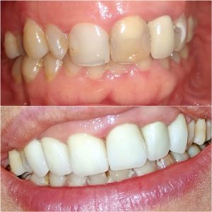 Bezmetalne krunice, moj stomatolog zarkovo, beograd