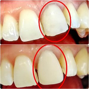 Fasete moj stomatolog zarkovo, beograd