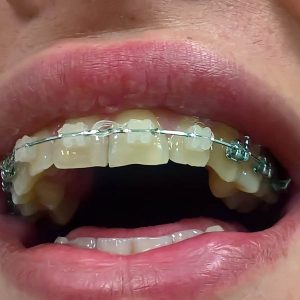 Fiksna sa safirnim bravicama moj stomatolog zarkovo