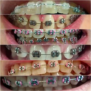 Fiksne proteze, moj stomatolog zarkovo, beograd