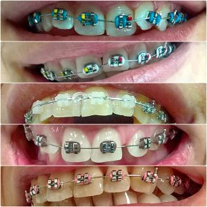 Fiksne proteze, moj stomatolog zarkovo, beograd