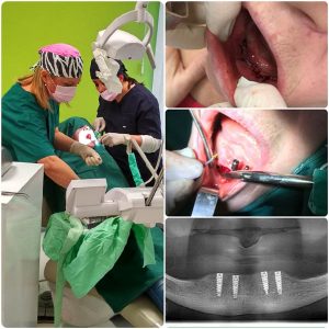 Implanti Zarkovo Cukarica Beograd Trgovacka zubar hirurg