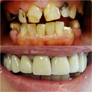 Metalokeramicke krunice moj stomatolog zarkovo, beograd