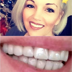 Metalokeramicke krunice, moj stomatolog, zarkovo, beograd