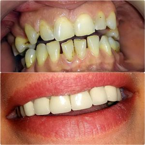 Metalokeramicke krunice most , zarkovo, beograd, moj stomatolog