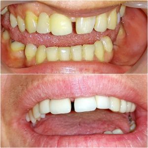 Metalokeramicke krunice solo, moj stomatolog zarkovo, beograd