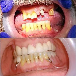 Skeletirana proteza, moj stomatolog zarkovo, beograd