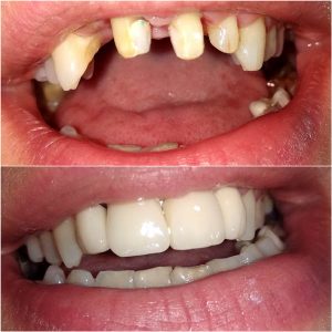 Metalokeramicke krunice, moj stomatolog zarkovo, beograd