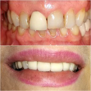 Metalokeramicke krunice, moj stomatolog, zarkovo, beograd