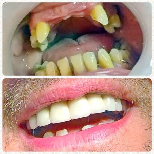 Metalokeramicke krunice, moj stomatolog zarkovo, beograd