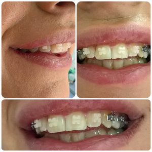 Safirna fiksna proteza, moj stomatolog zarkovo, beograd