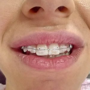 Safirna fiksna proteza, moj stomatolog zarkovo, beograd