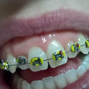 Fiksna proteza, moj stomatolog zarkovo, beograd