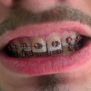 Fiksna proteza Zarkovo, moj stomatolog