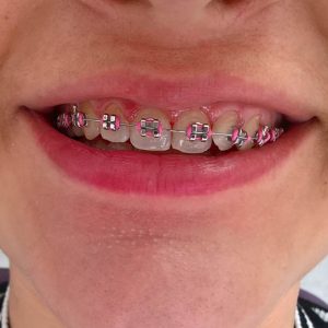 Fiksna proteza, moj stomatolog zarkovo, beograd