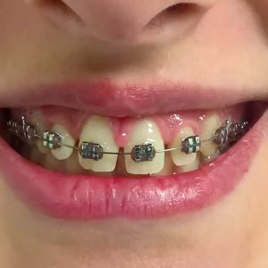 Fiksna proteza, moj stomatolog zarkovo, beograd