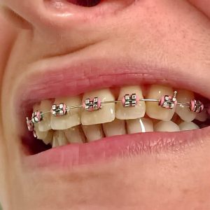 Fiksna proteza, moj stomatolog zarkovo, beograd