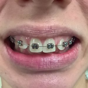 Fiksna proteza, moj stomatolog zarkovo, beograd