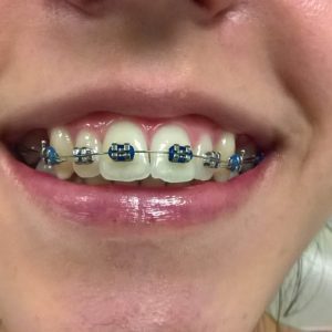 Fiksna proteza, moj stomatolog zarkovo, beograd