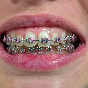 Fiksna proteza, moj stomatolog zarkovo, beograd