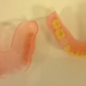 Valplast proteza silikonske proteze Zarkovo Trgovacka ordinacija LENA V stomatolog zubar