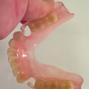 Valplast proteza silikonske proteze Zarkovo Trgovacka ordinacija LENA V stomatolog zubar